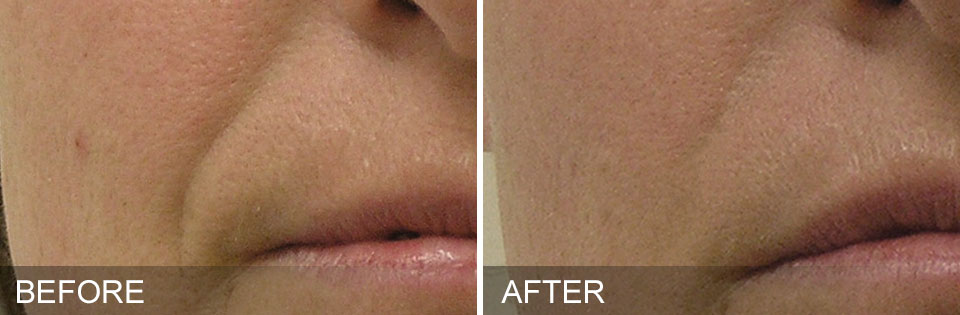 before-after-NasolabialFolds